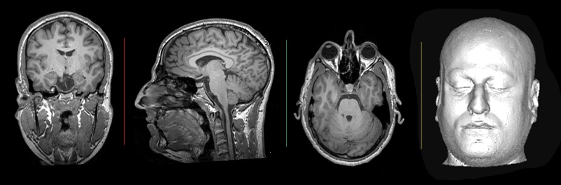 Anatomical Brain Imaging
